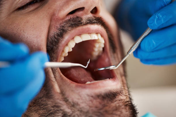 Best Emergency Wisdom Teeth Removal in Wendover, UT