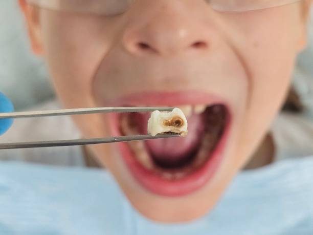 Best Emergency Tooth Extraction in Wendover, UT